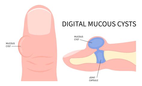 How To Treat a Digital Mucous Cyst on Your Toe - Foot and Ankle Group