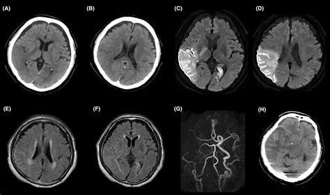 A case of acute cerebral infarction associated with an accessory middle cerebral artery in a ...