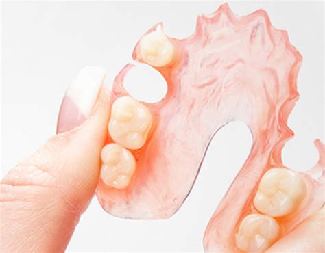 Get Flexible Partial Dentures Online | Dental Lab Direct