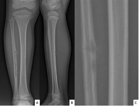 Anteroposterior (A) and lateral (B) radiographs of right fibula showing... | Download Scientific ...