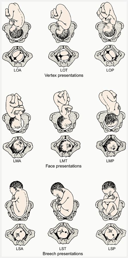 Optimal Fetal Positioning for a Better Birth | Baby position, Midwifery, Nurse midwife