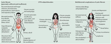 Cystic Fibrosis Life Expectancy 2024 - Nan Lauren