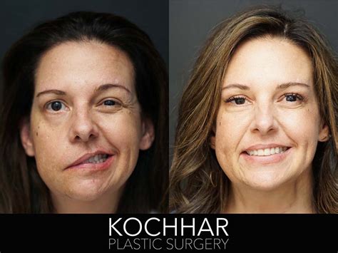 FACIAL PARALYSIS & FACIAL NERVE REANIMATION - Kochhar Plastic Surgery