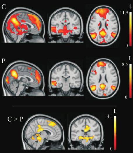 fMRI patterns of brain activation during the moral dilemma task ...