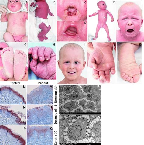 Clinical features of the reported patient. (A) An intertriginous... | Download Scientific Diagram