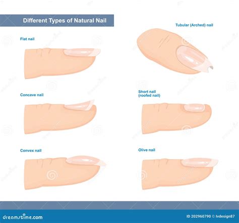 Different Types of Fingernail. Normal, Short, Roofed, Tubular, Arched, Flat, Convex and Concave ...