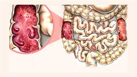 What is Gastrointestinal Tuberculosis and What are Its Symptoms?