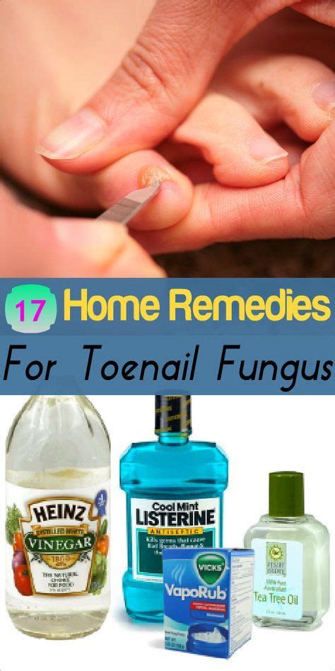 homeremedyshop: 17 Home Remedies for Toenail Fungus | Toenail fungus ...