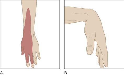 Radial Neuropathy (Saturday Night Palsy) | Anesthesia Key