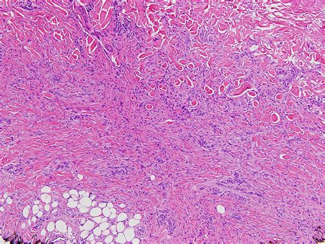 Deep Penetrating Dermatofibroma As A Variant of Benign Cellular Fibrous Histiocytoma ...