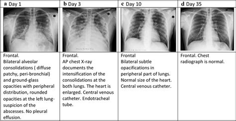 The evolution of pulmonary infiltrates in X-ray | Download Scientific Diagram