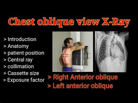 Chest Oblique view X-Ray # Part -1 # Right & Left Anterior oblique view ## By BL Kumawat # - YouTube