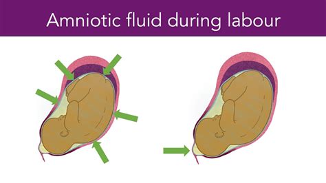 Amniotic Fluid During Labour - YouTube