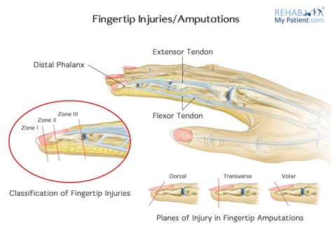 fingertip injuries – Pedmore Medical