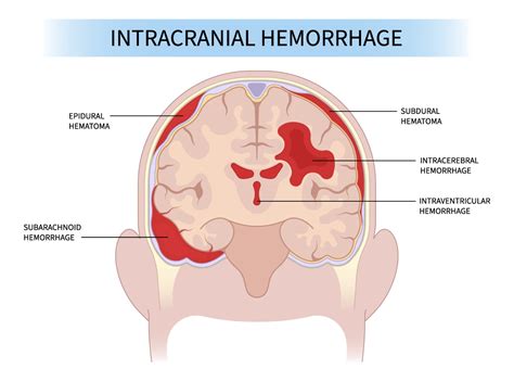 Intracranial Hemorrhage | Aurora Health Care