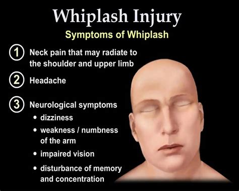 Whiplash Injury Animation - Everything You Need to Know - Dr. Nabil Ebraheim, M.D. - YouTube