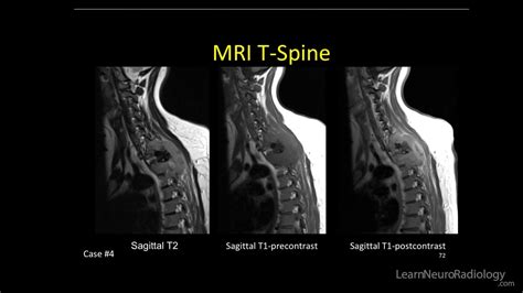 Lesions On Mri T Spine