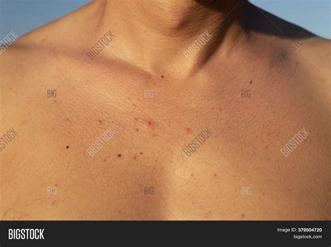 Red Acne Rash Chest Image & Photo (Free Trial) | Bigstock