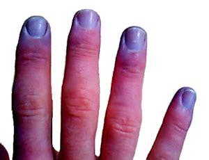 Cyanosis – Definition, Causes, Symptoms, Treatment, Diagnosis