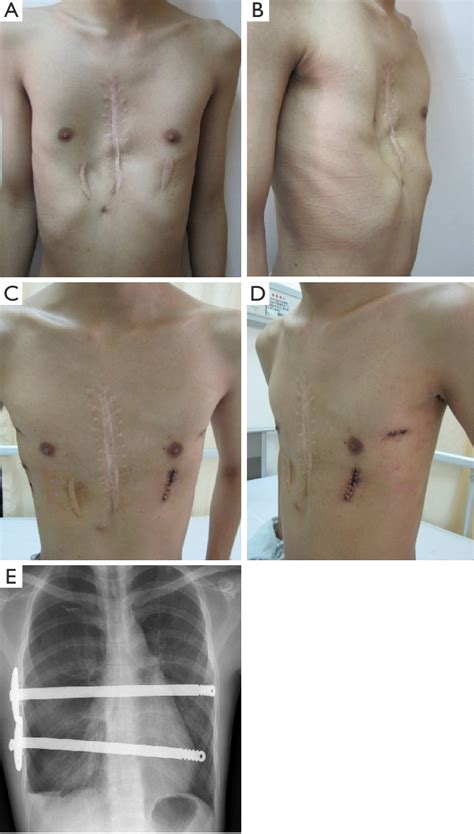 Pectus Excavatum Surgery