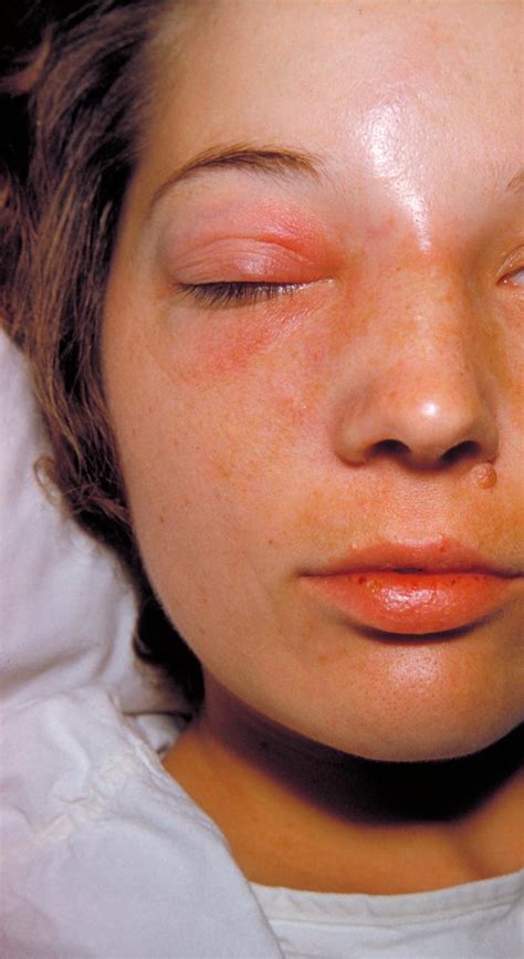 Orbital cellulitis - Physician Assistant Exam Review