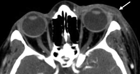 Nontraumatic Orbital Conditions: Diagnosis with CT and MR Imaging in ...