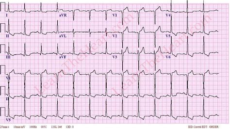 Left Ventricular Hypertrophy With Strain Pattern (Example 3) | LearntheHeart.com