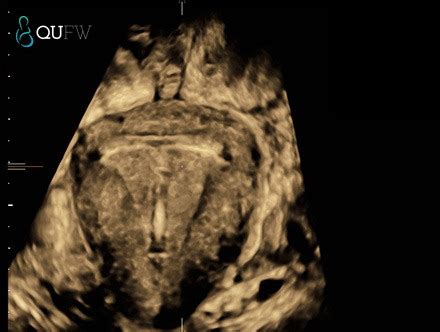 Gynaecology Ultrasound