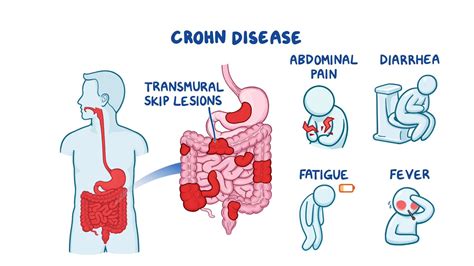 Crohns Disease Stool