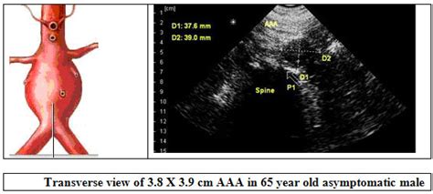 The Role Of Office-Based Ultrasound in Screening for Abdominal Aortic Aneurysms