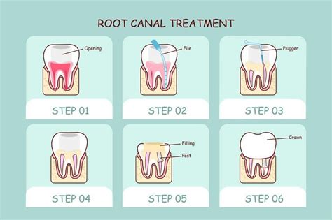 Step by Step Explanation of Root Canal Treatment Procedure - Family Dental Care