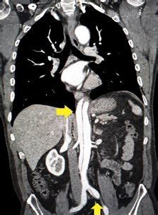 Computed tomography (CT) scan: dissection of the aortic wall from the... | Download Scientific ...