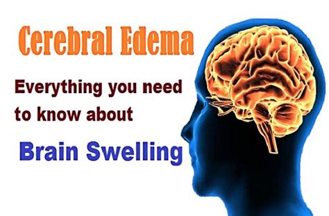 Cerebral Edema (Brain Swelling) - Types, Symptoms, Causes and Treatment