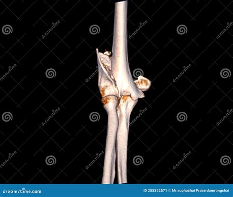 CT scan of elbow joint stock illustration. Illustration of doctor - 255352571