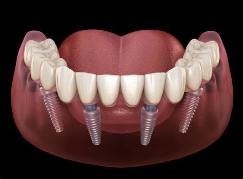 The History of All-on-4 Dental Implants - Advanced Family Dentistry ...