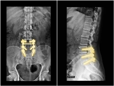 Lumbar Fusion - Pomona, CA & Arcadia, CA: Inland Neurosurgery Institute ...