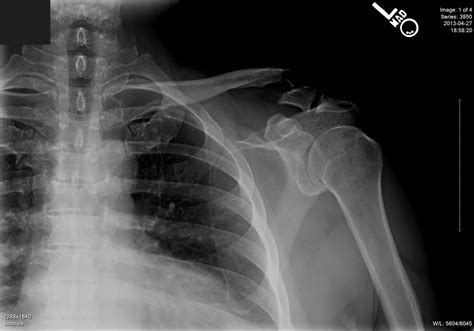 Clavicle Shaft Fractures - Trauma - Orthobullets