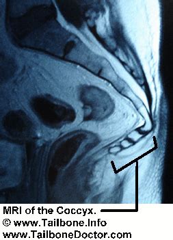 Did MRI show the tailbone | Tailbone Doctor