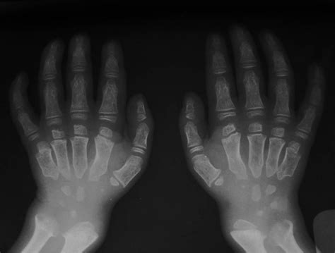 Morquio syndrome - hand | Radiology Case | Radiopaedia.org | Radiology ...