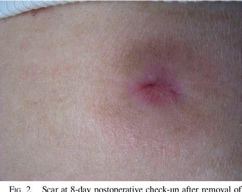 Closure of Gastrocutaneous Fistula Using Autologous Blood Product ...