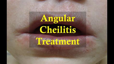 How to cure Angular Cheilitis Naturally - YouTube