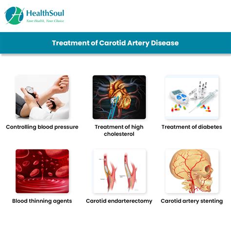 Carotid Artery Disease: Causes and Treatment – Healthsoul