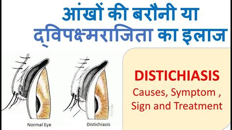 Distichiasis || Causes and treatment of distichiasis ...