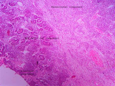 Wilm’s tumor – UG slide – Histopathology.guru