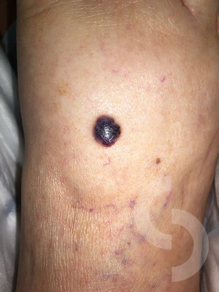 Malignant Melanoma – dr Sonja Cerovac