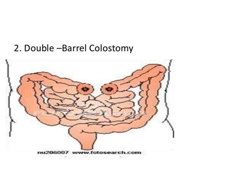 Colostomy