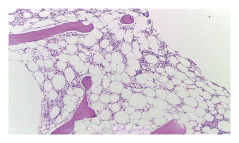 Fat-filled hypocellular bone marrow biopsy without fibrosis or... | Download Scientific Diagram