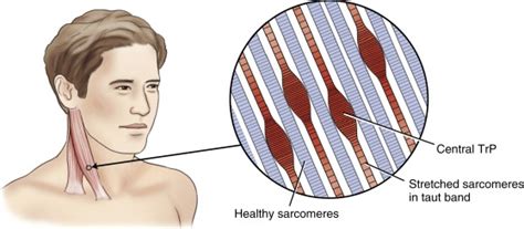 myofascial trigger point Archives - Learn Muscles