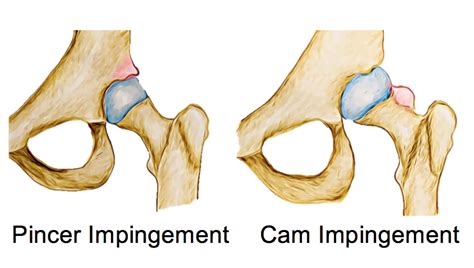 Femoroacetabular Impingement (FAI)