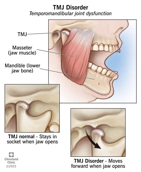 TMJ Disorders: Symptoms, Causes & Treatment